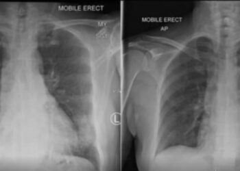 Paracetamol, oksimetar, vitamini… Evo šta sve trebate imati u kućnoj apoteci za slučaj da se zarazite koronom