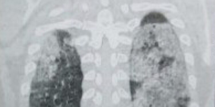 Sarajevo: Ovo je CT pluća jednog od 430 hospitalizovanih u KS – mlad čovjek, nepušač: Za one koji ne znaju, zdrav je crni dio